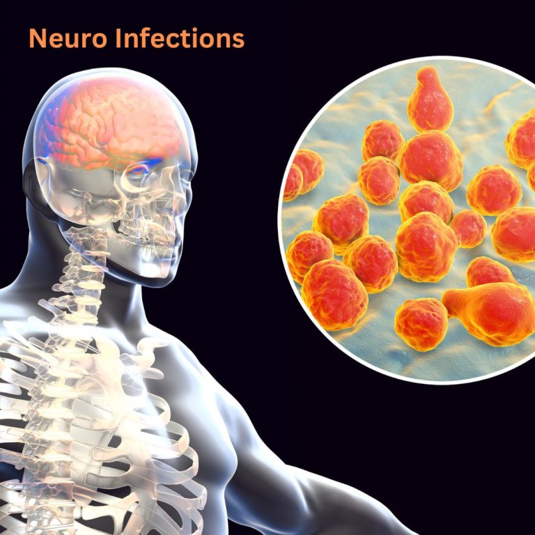 Neuro Infection Treatment